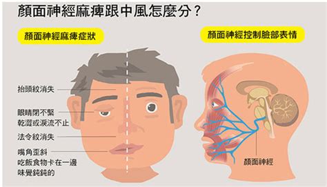 右側臉|右臉麻麻的神經外科問題：可能是何種疾病？